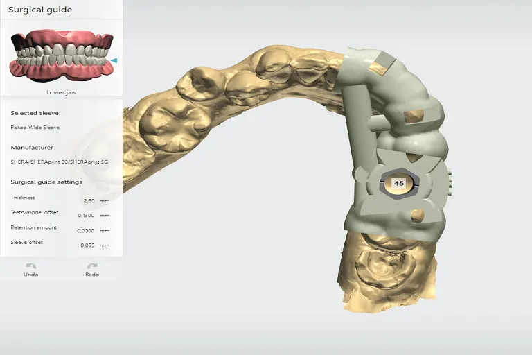 Computer Guided Implantology