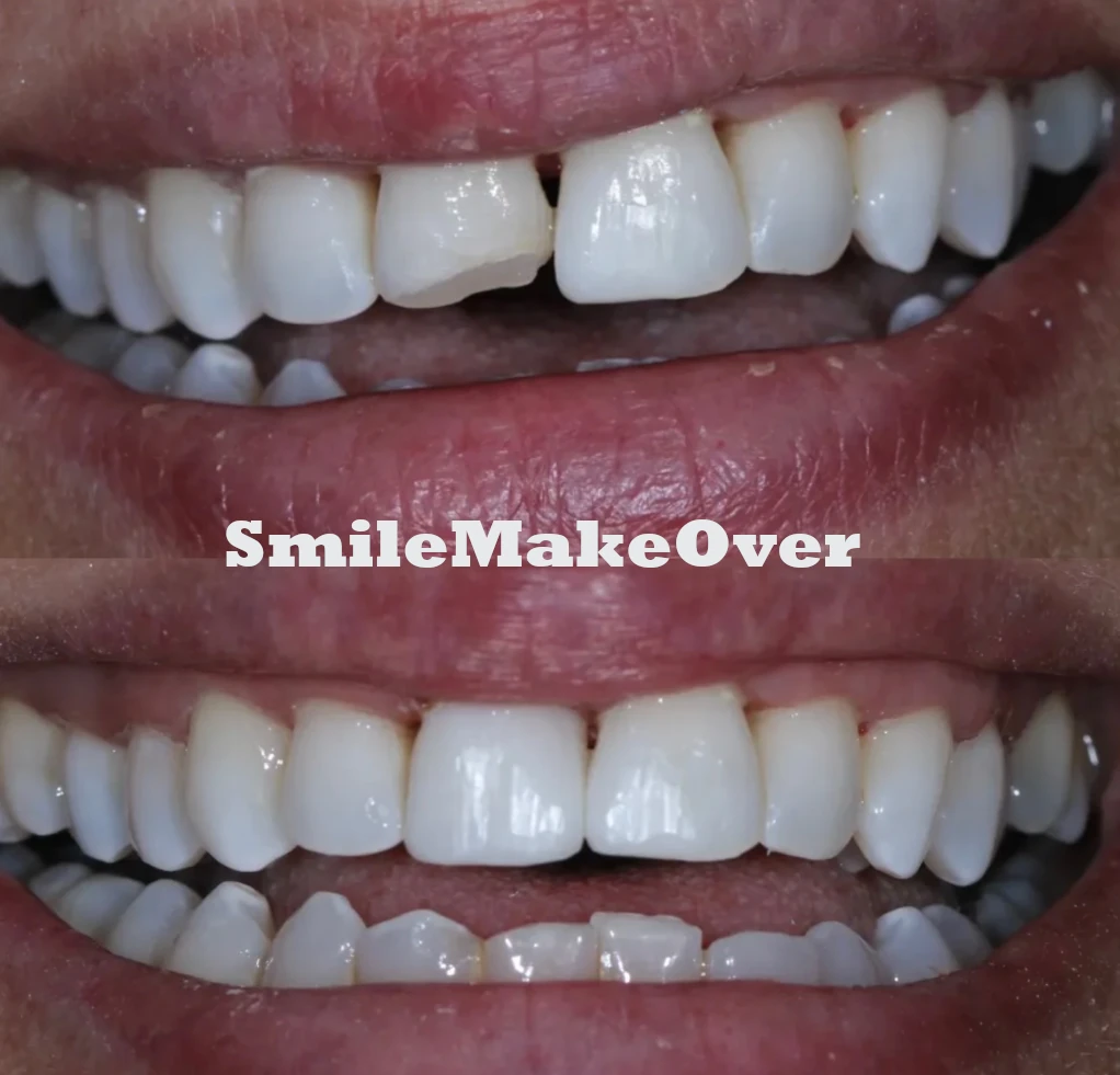 Veneers Image